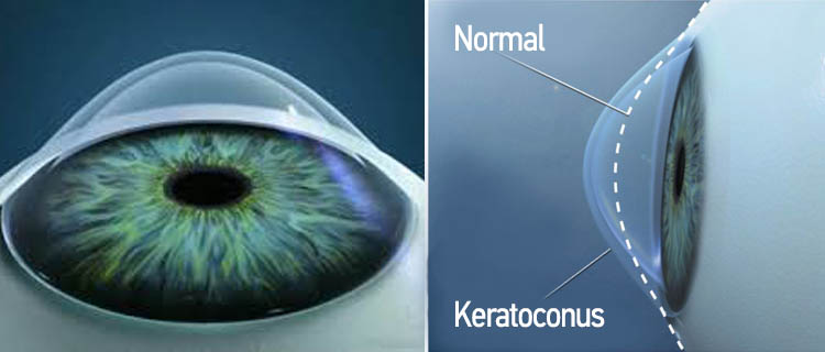 Keratoconus/Normal