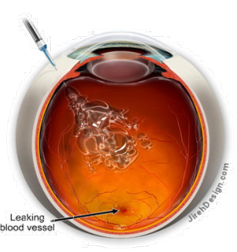 Дистрофия сетчатки глаза лечение санкт петербург