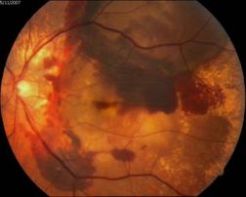Дистрофия сетчатки глаза лечение спб