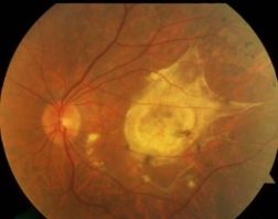 Дистрофия сетчатки глаза лечение спб